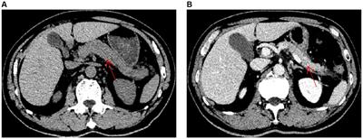 Acute abdominal pain as the first symptom of Chlamydia psittaci pneumonia complicated by acute pancreatitis: a case report
